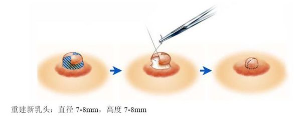 女性乳头变大的原因