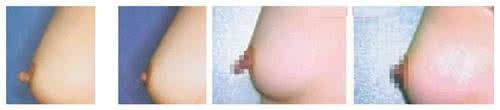 乳头缩小术前要准备什么