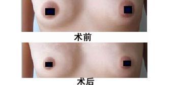 为什么乳头整形如此流行
