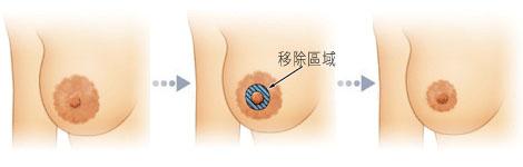 上海乳头缩小术后会留下疤痕吗