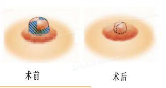 乳头缩小术前后照片