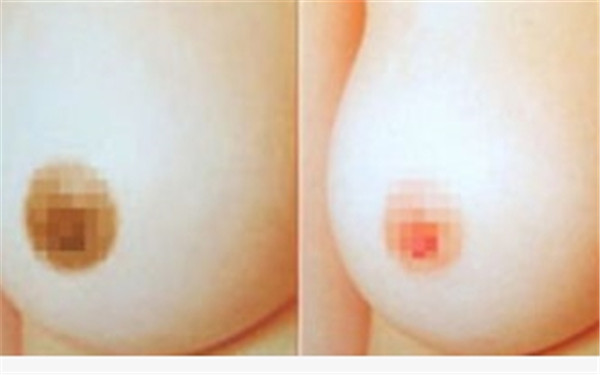 缩小乳头要多少费用