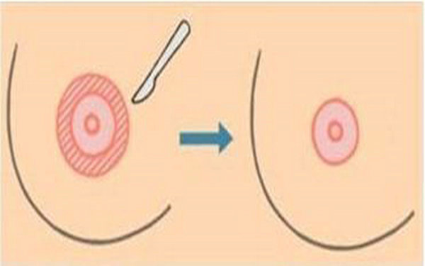 乳头缩小最好的办法