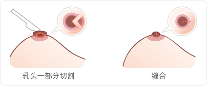 断奶后奶头很大怎么改善