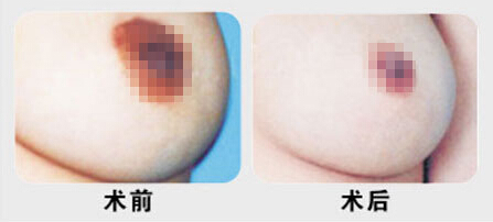 矫正乳头肥大术真的无疤吗