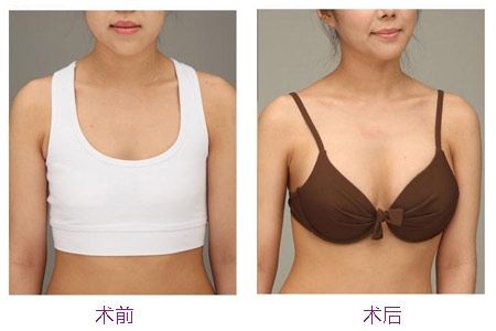 胸小如何丰胸快