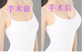 上海假体隆胸的费用