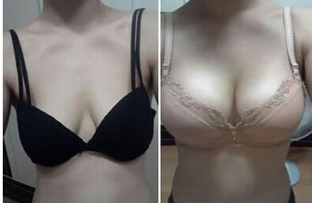 麦格假体隆胸五大优势