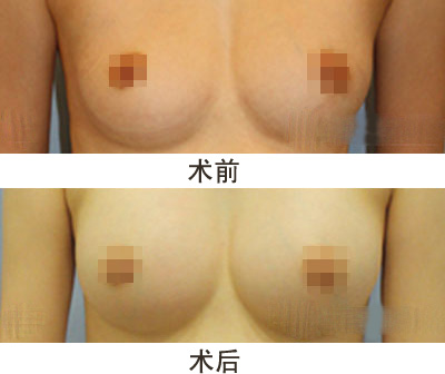 天生胸部小怎么办