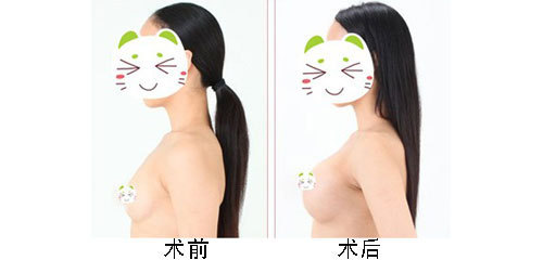 最常用的隆胸方法