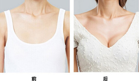 胸小怎么隆胸
