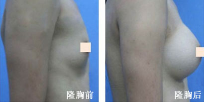 硅胶隆胸有没有危害