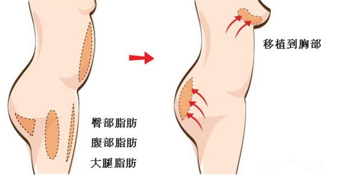 丰胸后遗症有哪些？