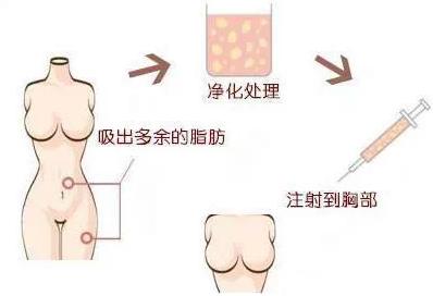 自体脂肪隆胸有哪些风险需要规避?