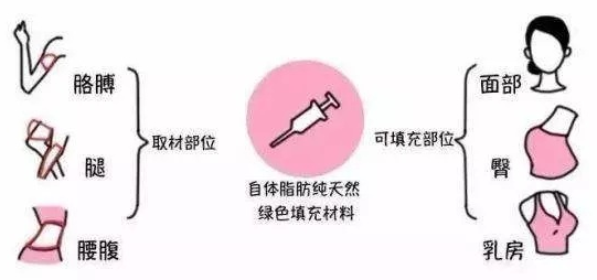 脂肪填充术有什么后遗症