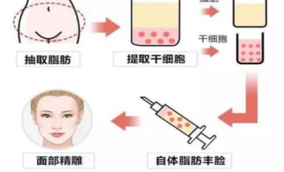 脂肪填充3个月后会自然吗