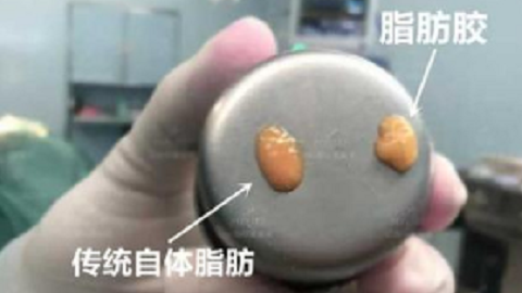 脂肪胶和自体脂肪填充有什么区别