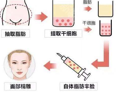 夏天适合做自体脂肪填充吗