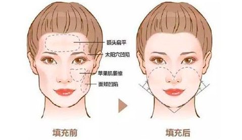 自体脂肪填充怎么护理才能达到最佳的术后效果