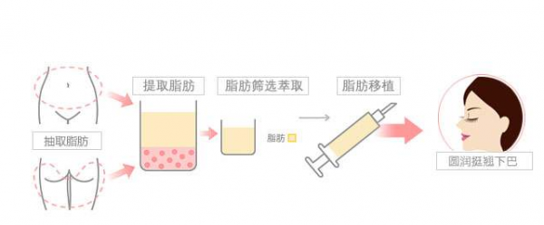 脂肪填充哪家医院好