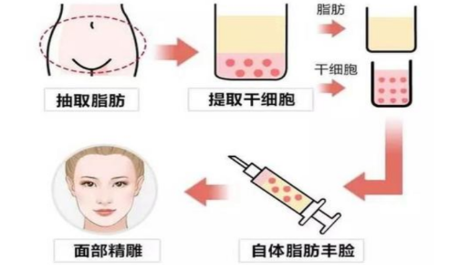 脂肪移植填充多久自然