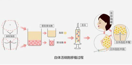 自体脂肪是什么
