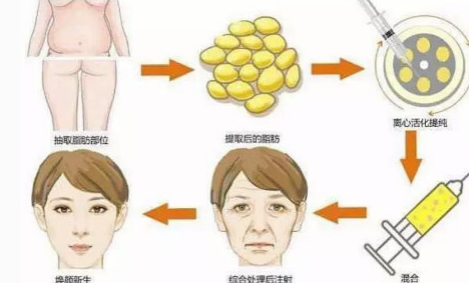 自体脂肪填充是什么