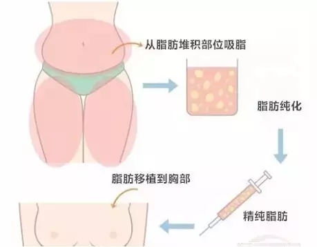 巧用身体“软黄金”自脂填充了解下