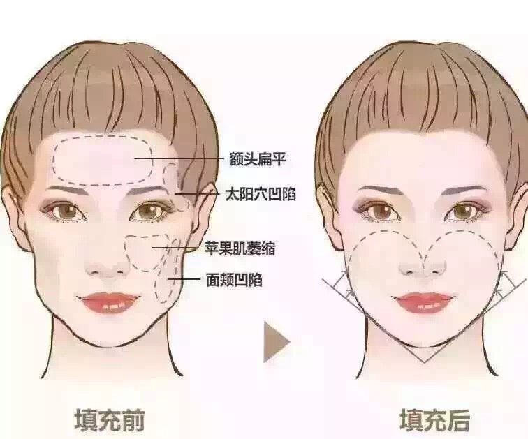 额头脂肪填充多少钱