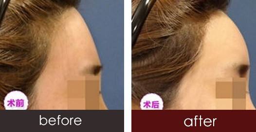 自体脂肪面部填充多少钱