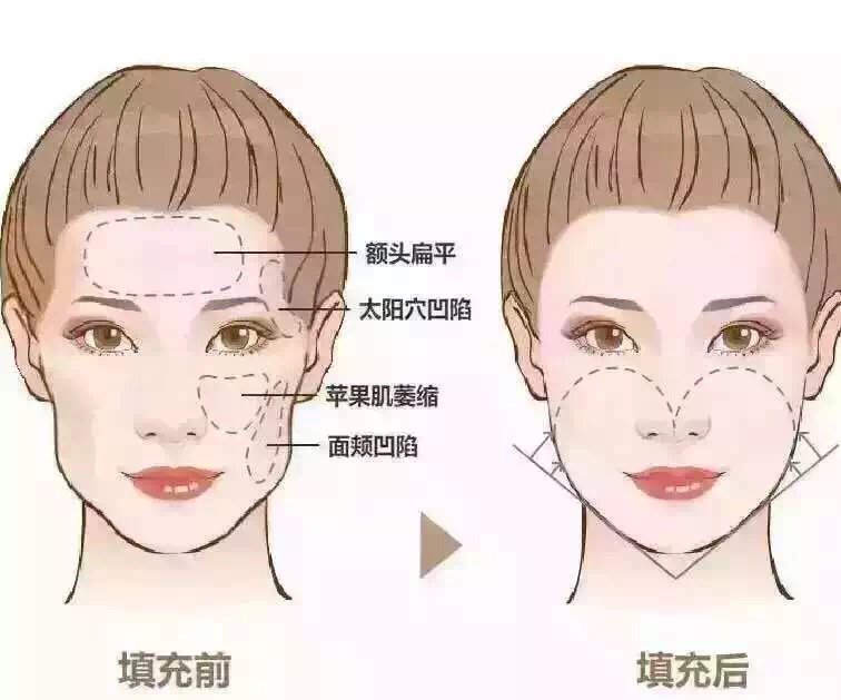 自体面部脂肪填充的费用