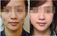 脸部脂肪填充多少钱