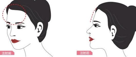 额头脂肪填充的价格