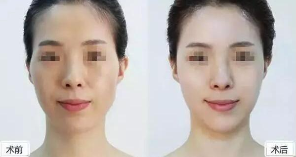 自体脂肪面部填充注意