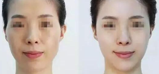 脂肪填充对身体有害吗
