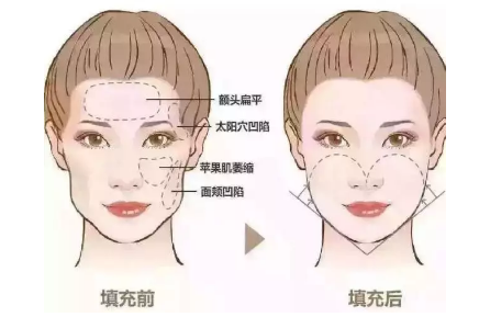 局部脂肪填充多少价位