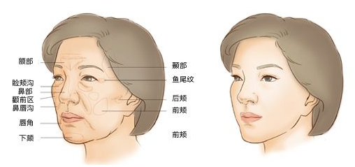 局部脂肪填充多少价位