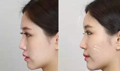 北京自体脂肪丰面颊效果维持多久