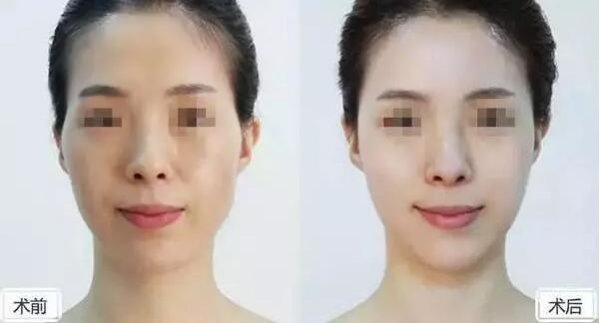 自体填充面部价格多少