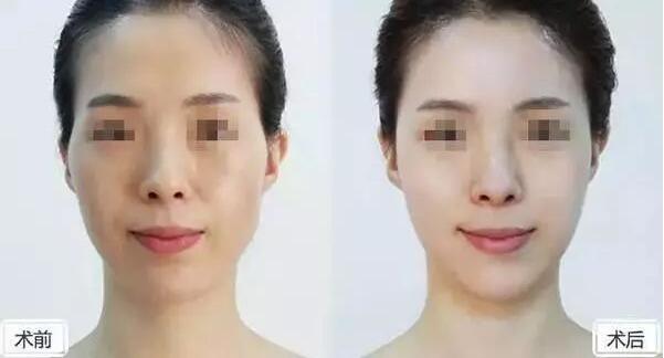 自体填充面部价格多少