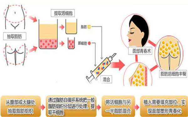 脂肪填充是大手术吗