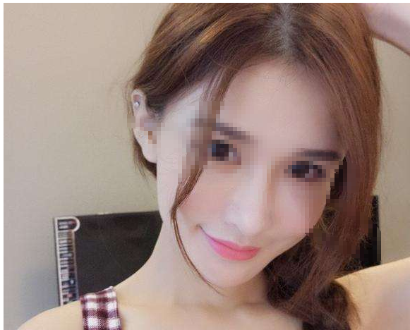 脸部脂肪填充术术后效果好吗