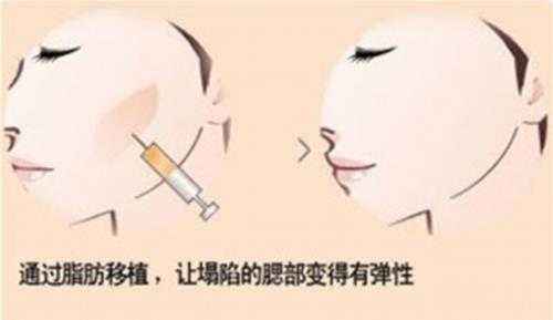 脸部脂肪填充术效果如何