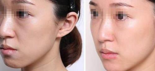 脂肪填充有硬块怎么办