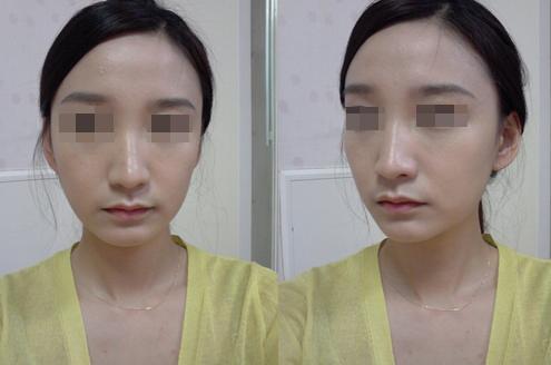 自体填充有硬块怎么消