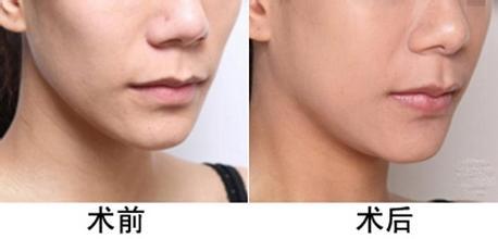 脂肪填充为什么会肿呢