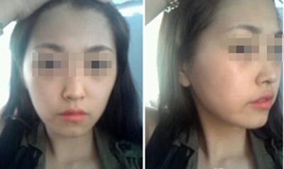自体脂肪填充出现硬块