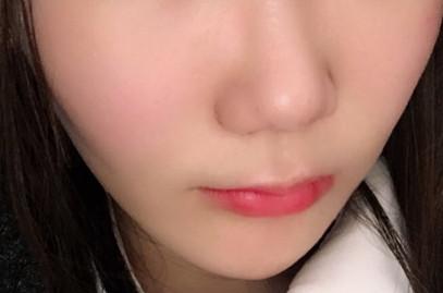 自体脂肪填充后最忌讳什么