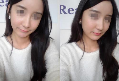 自体脂肪第二天很肿怎么办