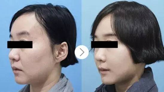 脸部脂肪填充副作用